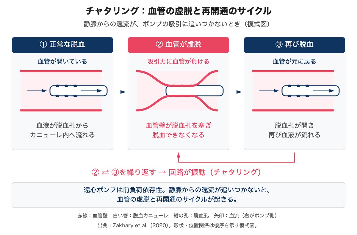 正常な脱血、血管の虚脱による脱血孔の閉塞、血管が戻った後の再脱血を示す3コマ。還流不足では虚脱と再開通を繰り返す