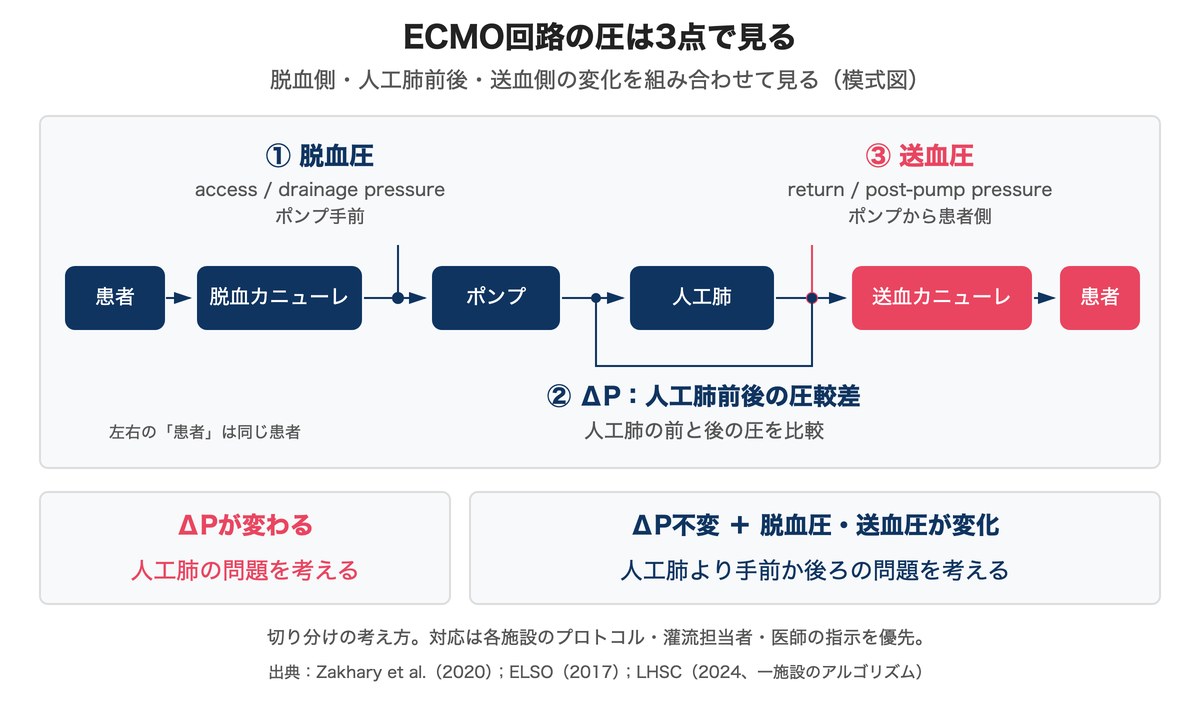 ECMO回路の脱血圧、人工肺前後の圧較差ΔP、送血圧の位置と、ΔPの変化から異常部位を切り分ける考え方