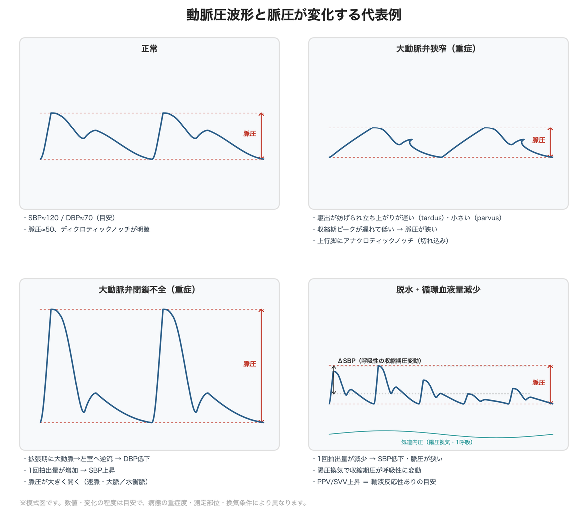 脈圧が変化する代表例(正常・大動脈弁狭窄・大動脈弁閉鎖不全・脱水)の波形比較