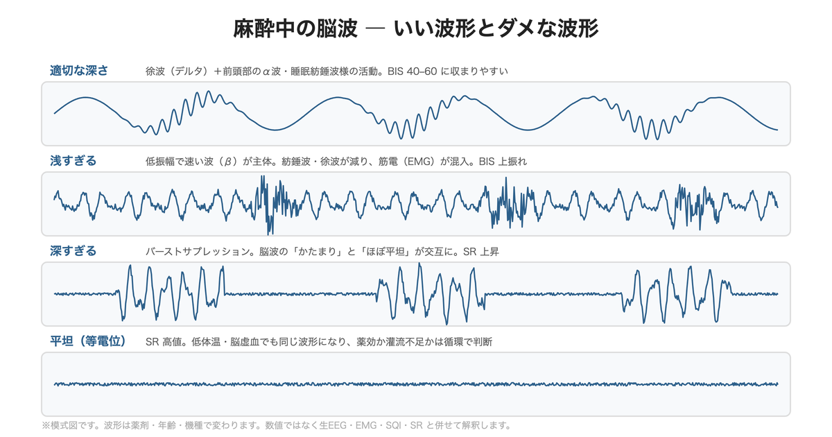 麻酔中の脳波 ― いい波形とダメな波形(適切・浅すぎ・深すぎ・平坦)