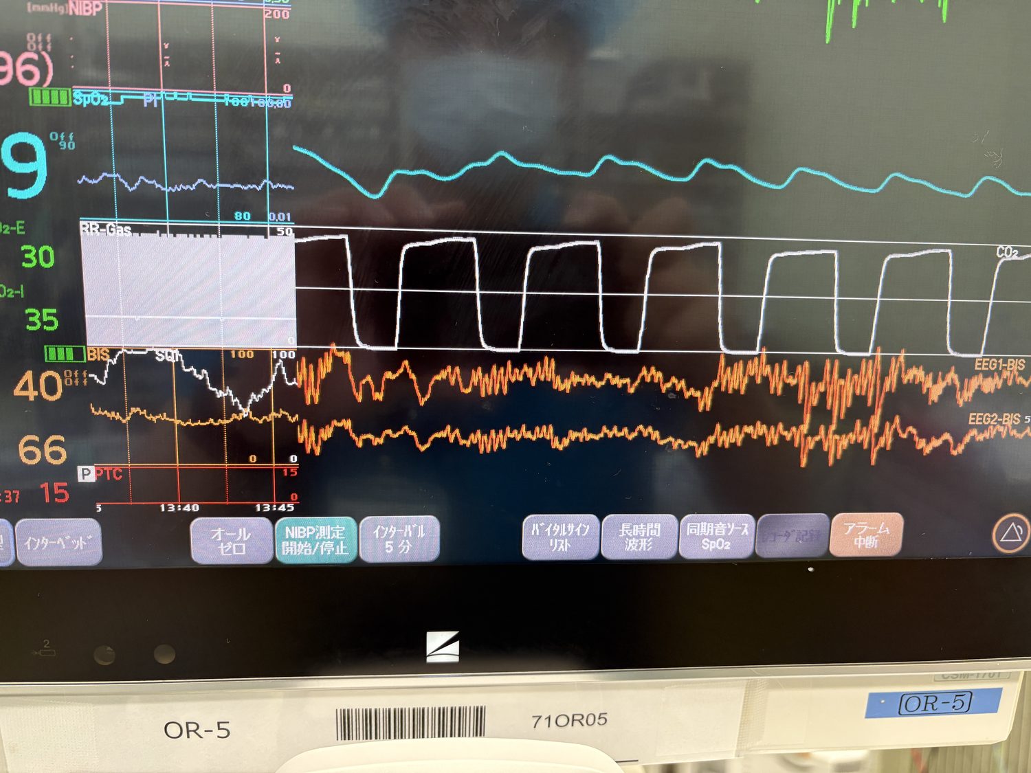 実際のモニタ画面。BIS値・SQIのトレンド(左)と生EEG(EEG1/EEG2)、カプノグラムを並べて表示している