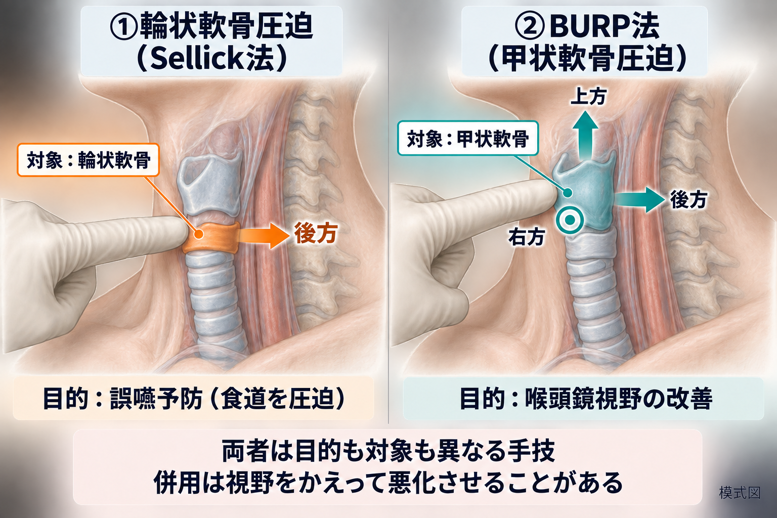 輪状軟骨圧迫(Sellick法)とBURP法(甲状軟骨圧迫)の違い