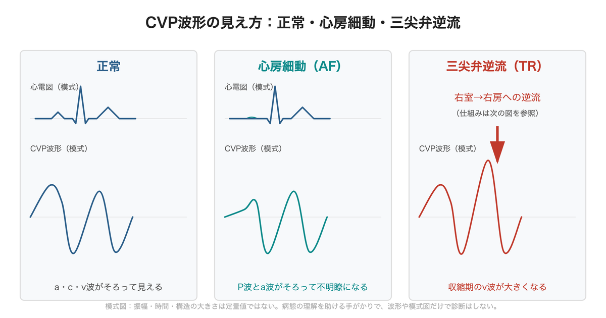 CVP波形の見え方の模式図。正常ではa・c・v波がそろうが、心房細動ではP波とa波がそろって不明瞭になる。三尖弁逆流では収縮期のv波が大きくなる。