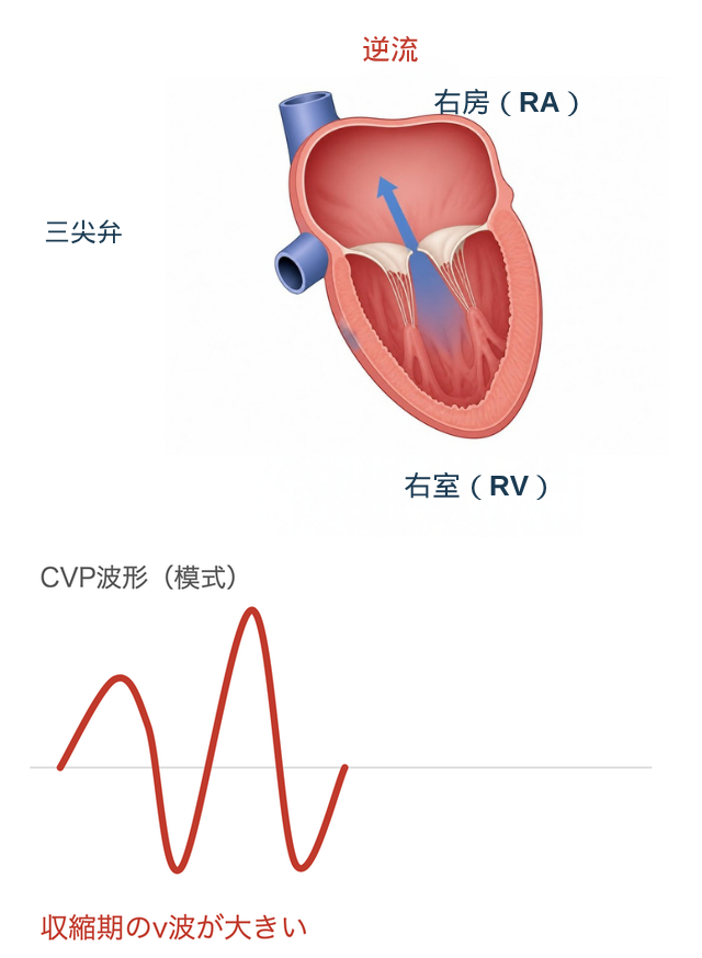三尖弁逆流の仕組みを示す心臓断面イラストと、収縮期のv波が大きくなるCVP波形を並べた図。右室から右房へ血液が逆流する様子を青い矢印で示す。