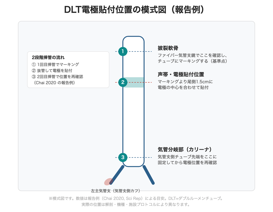 DLT電極貼付位置の模式図(披裂軟骨から尾側1.5cmに電極中心を合わせる。報告例)