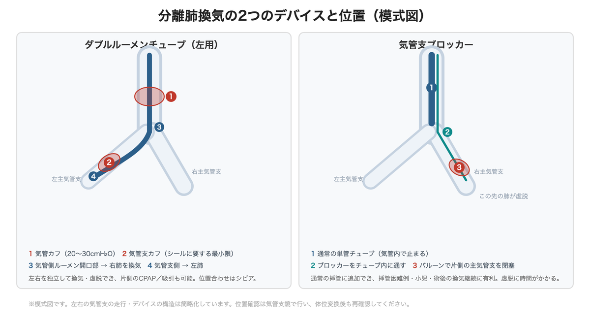 分離肺換気の2つのデバイスと位置(左:ダブルルーメンチューブ/右:気管支ブロッカー)