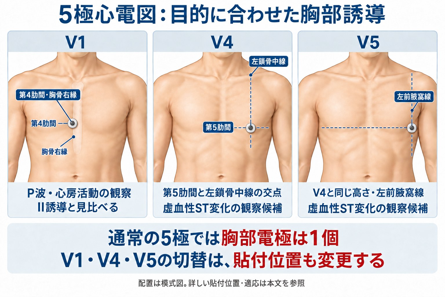 通常の5極心電図の胸部電極の選択。V1はP波・心房活動をII誘導と比較し、V4とV5は虚血性ST変化の観察候補とする。胸部電極は1個であり、誘導を変更するときは貼付位置も変更する。
