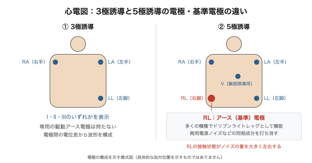 3極誘導と5極誘導の電極構成の違い(5極のRLがアース/基準電極として機能)