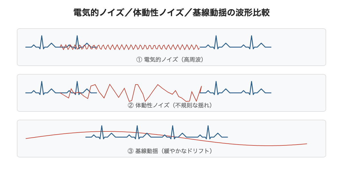 電気的ノイズ/体動性ノイズ/基線動揺、3種類の波形パターンの比較