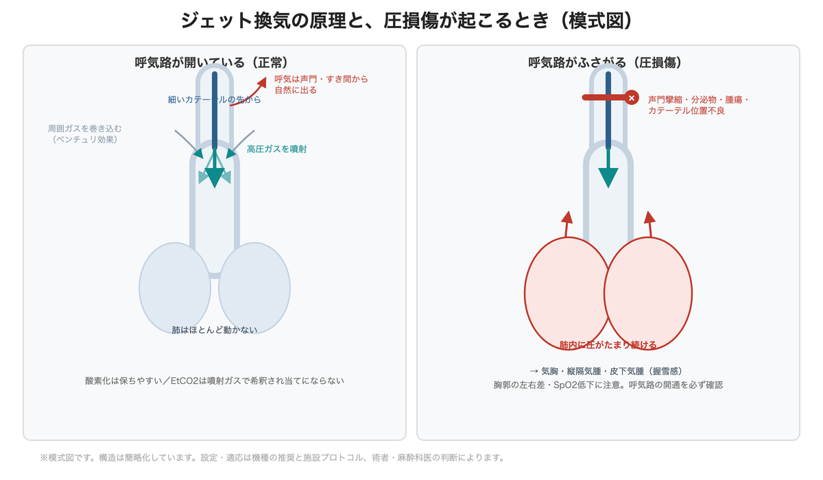 ジェット換気の原理と、圧損傷が起こるとき