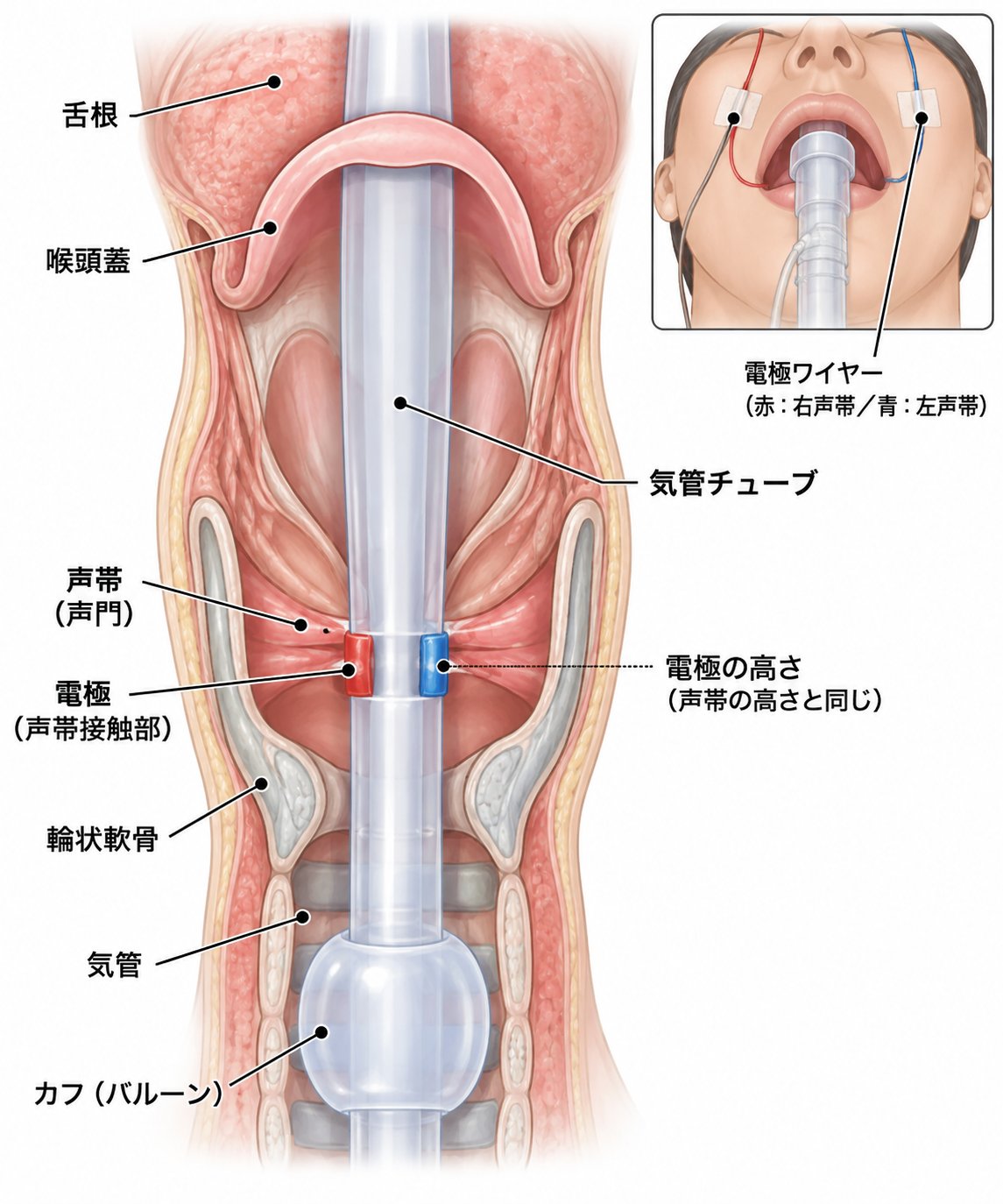 NIM TUBEの電極は声帯の高さに合わせて位置決めする。電極ワイヤーは赤が右声帯、青が左声帯