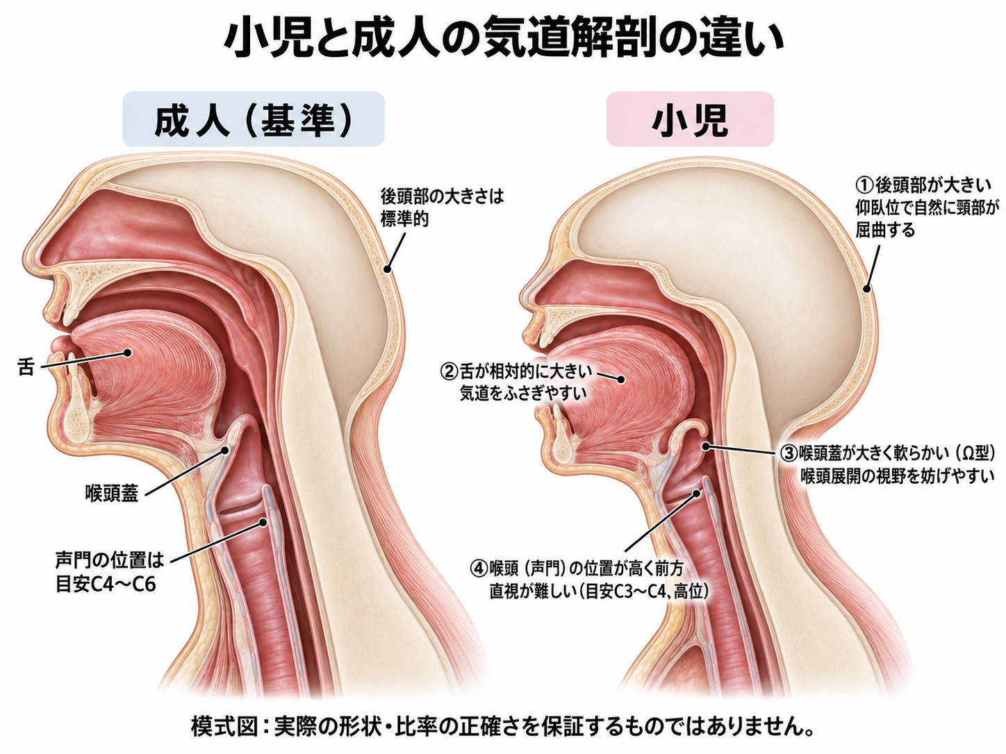 小児と成人の気道解剖の違い(実写風イラスト)