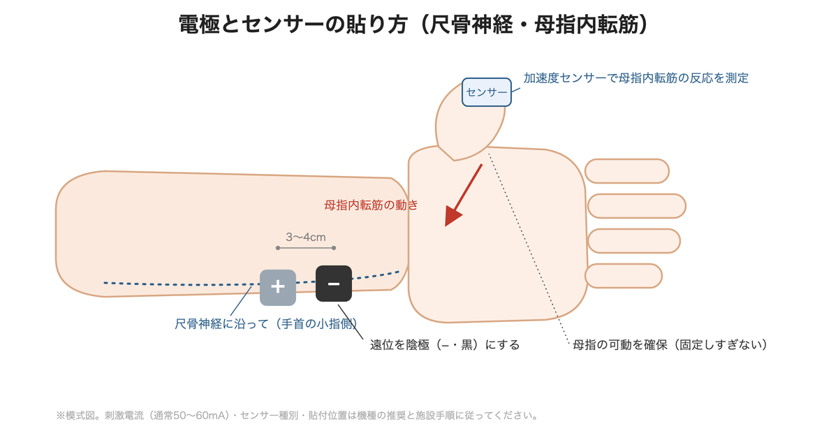 電極とセンサーの貼り方 ― 手首の尺骨神経に沿って電極を貼り、遠位を陰極(黒)、母指内転筋の反応をセンサーで測定する