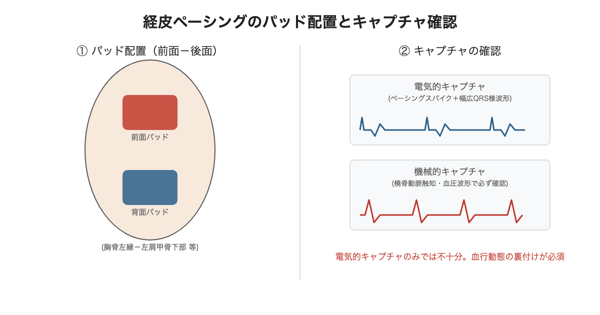 経皮ペーシングのパッド配置とキャプチャ確認