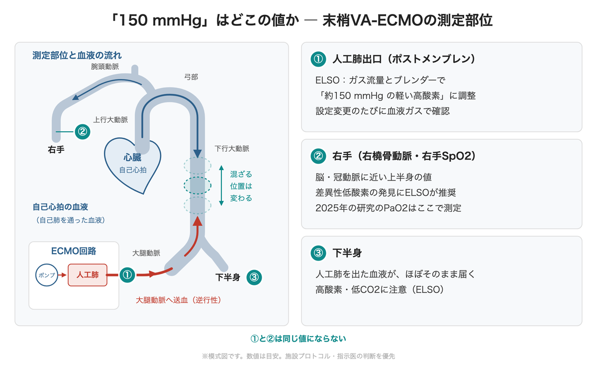 末梢VA-ECMOの測定部位 ― 人工肺出口・右手・下半身