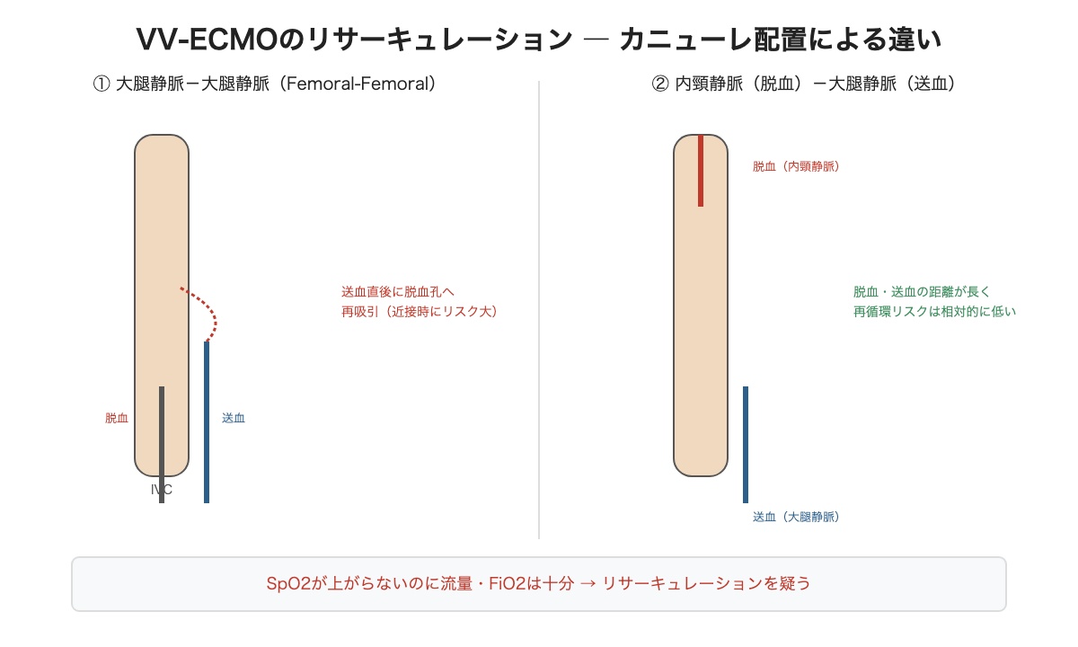 VV-ECMOのリサーキュレーション ― カニューレ配置による違い
